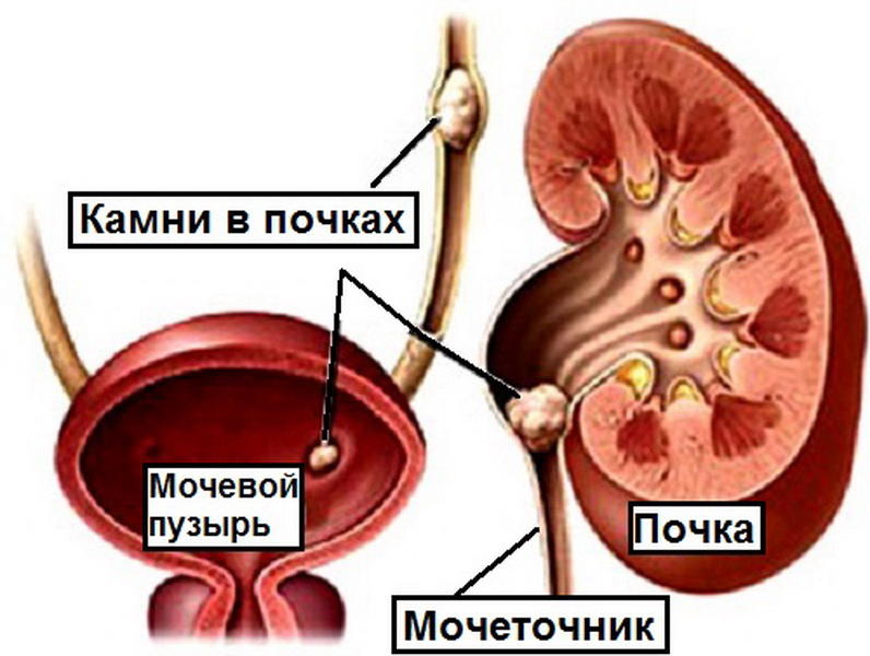 Камни в почках