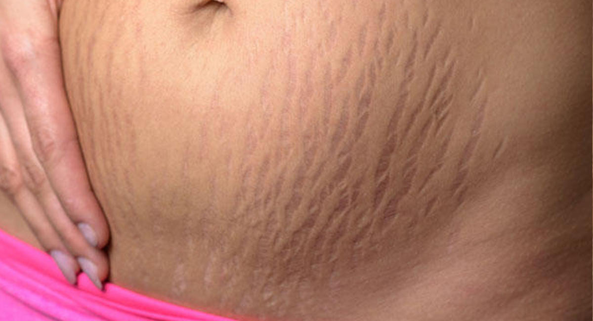 Naked pictures of girls with stretch marks