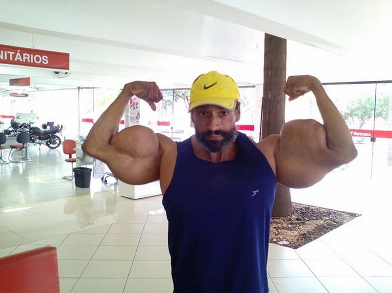 Бразильский Халк вводит в мышцы синтетическое масло, чтобы стать еще больше