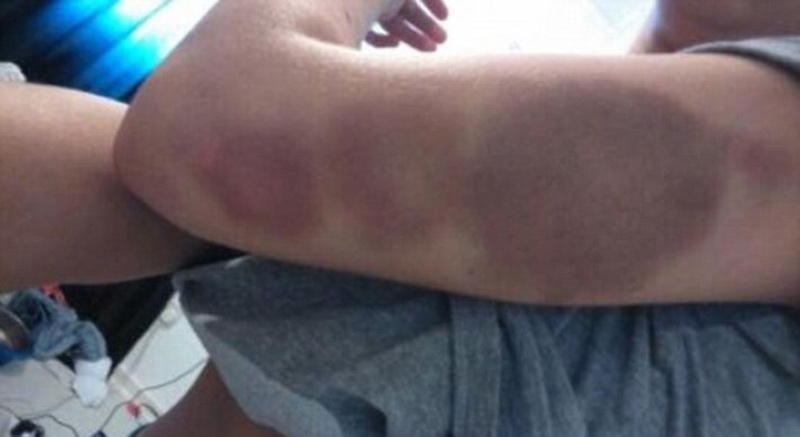A DOMESTIC abuse victim has revealed sickening pictures of the horrific injuries she suffered at the hands of her former partner. Brave Kelsie Skillen was beaten to a pulp by her vicious boyfriend James McCourt, 19, at the home they shared together. The graphic pictures show her injuries after being subjected to a beating lasting four hours in June this year. Kelsie, 19, a make up artist from Bishopbriggs, near Glasgow, was rushed to hospital following the attack which left her with cuts to her face and covered in bruises. McCourt has been remanded in custody to await sentencing after he admitted the brutal assault during an appearance at Glasgow Sheriff Court. Kelsie said she wanted to warn other people about McCourt so that they don't suffer the same fate as her.