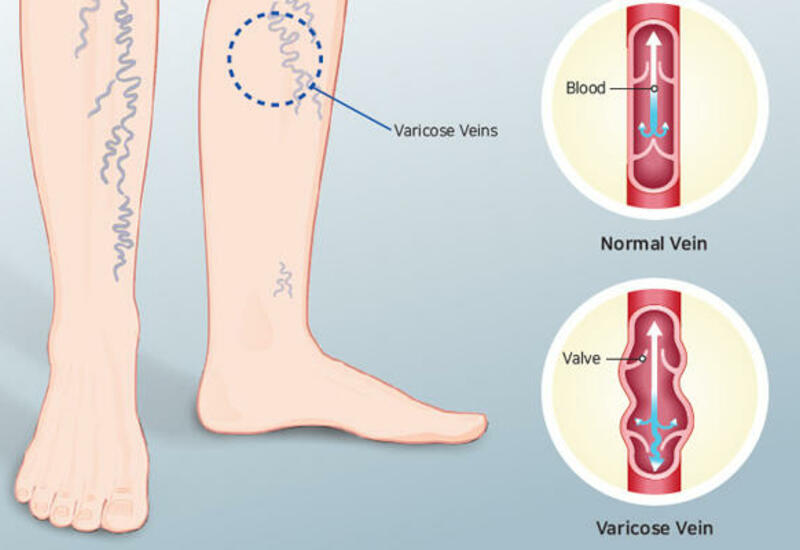Варикоз Вен На Ногах Лечение Профилактика