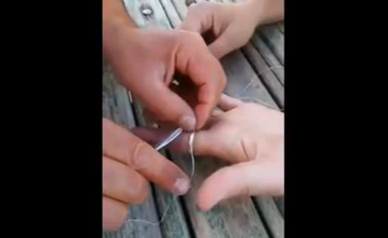 Как снять застрявшее кольцо с пальца