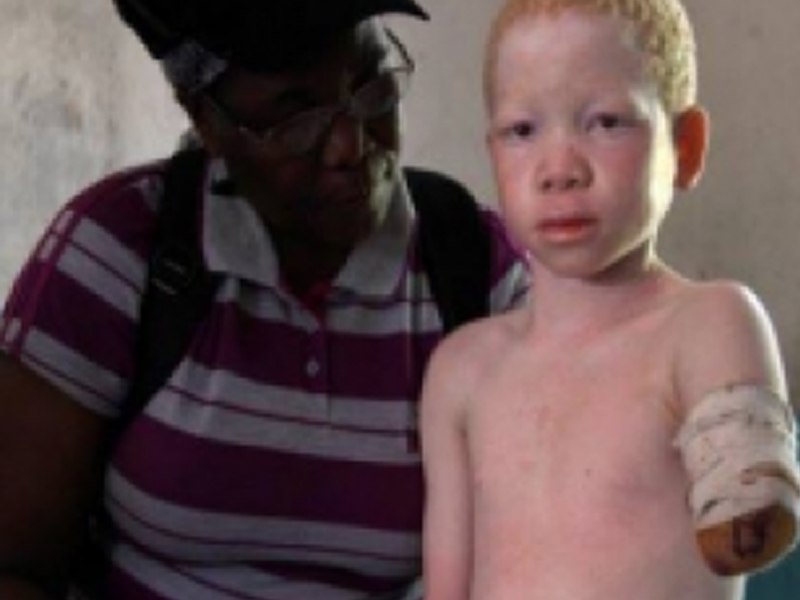 В Танзании шестилетнему альбиносу отрубили кисть руки