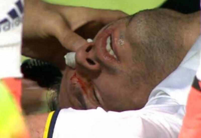 Знаменитый голландский футболист получил жуткую травму глаза