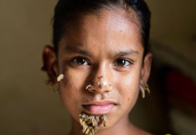 В Бангладеш 10-летняя девочка превращается в дерево