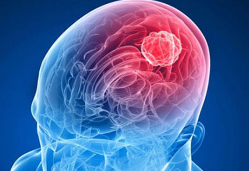 Опухоль мозга вылечат с помощью вируса бешенства