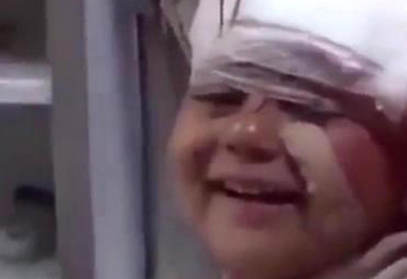 Пользователей Сети поразила улыбка раненой во время взрыва сирийской девочки