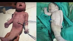 В Индии женщина родила "ребенка-русалку"