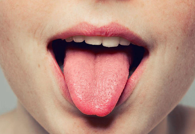 Tüklü dil sindromu - 100 insandan 13-ündə rast gəlinir