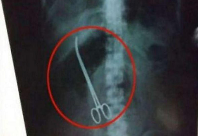 У пациентки обнаружили ножницы в организме спустя три месяца после операции