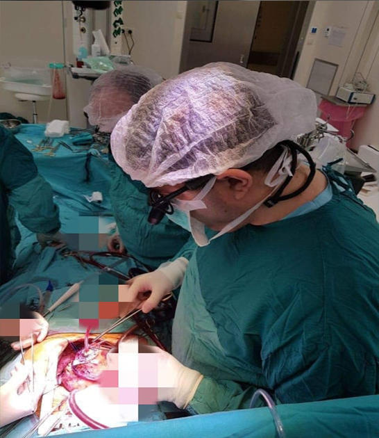 В Азербайджане пациенту впервые пересадили искусственное сердце