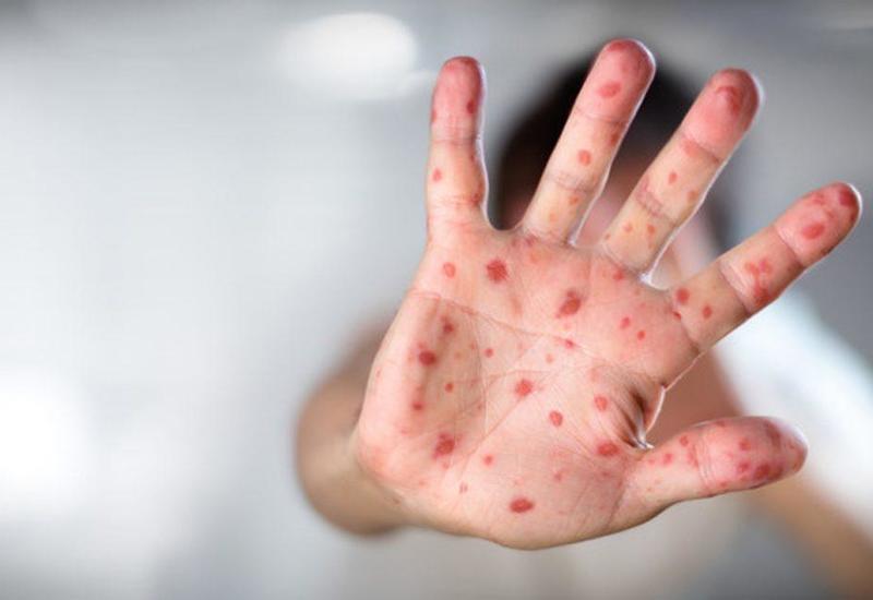 ЮНИСЕФ: Глобальная эпидемия кори вызвана отсутствием прививок у многих жителей планеты