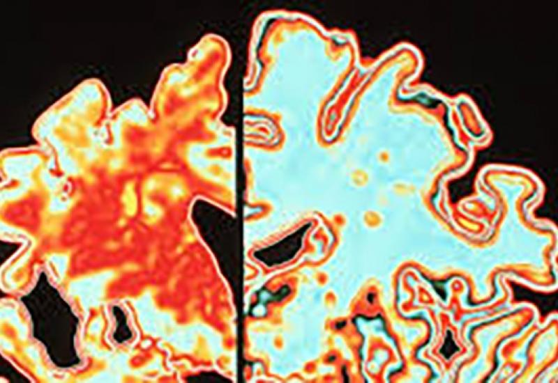 Найден белок для защиты мозга от болезни Альцгеймера