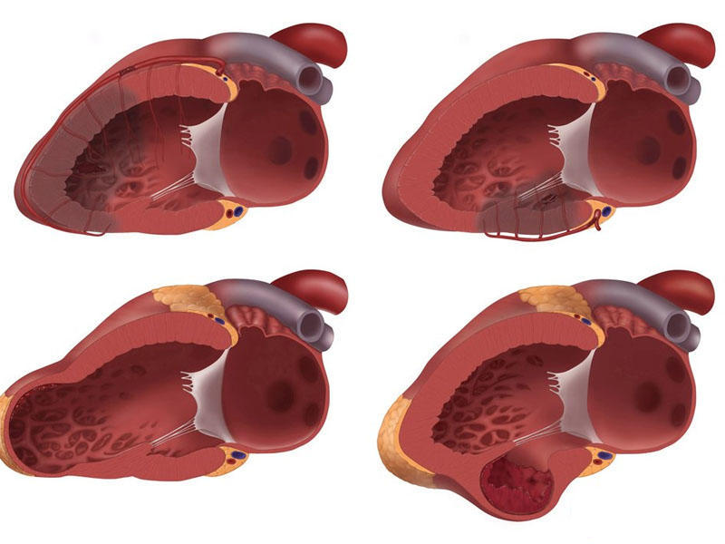 Инфаркт на картинке