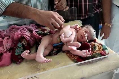 Ребенок с четырьмя ногами и тремя руками родился в Индии