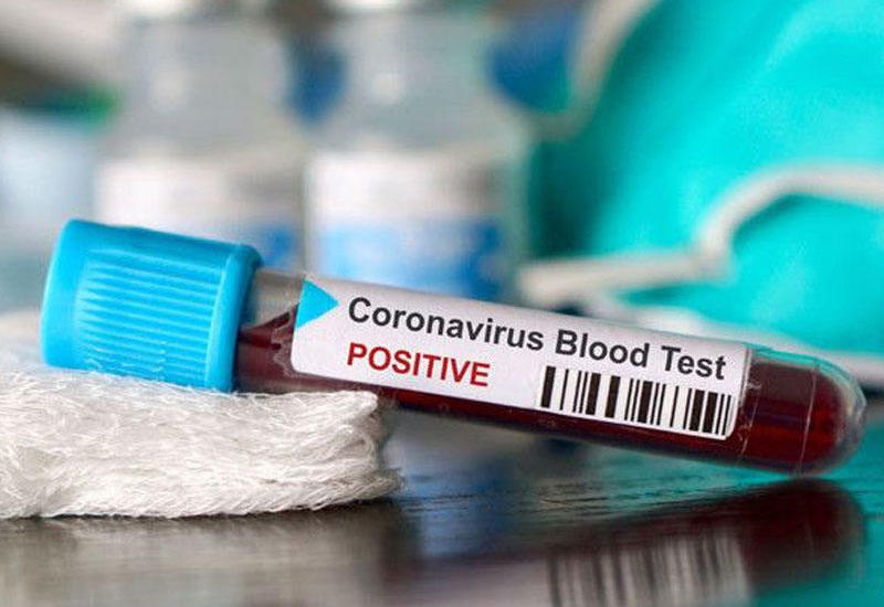 Alimlər koronavirusun gerçək yoluxma sayını müəyyənləşdirdilər