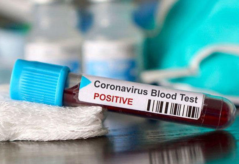 ABŞ-da koronavirusu ev şəraitində müəyyən edən testlərin keçirilməsinə lisenziya verilib