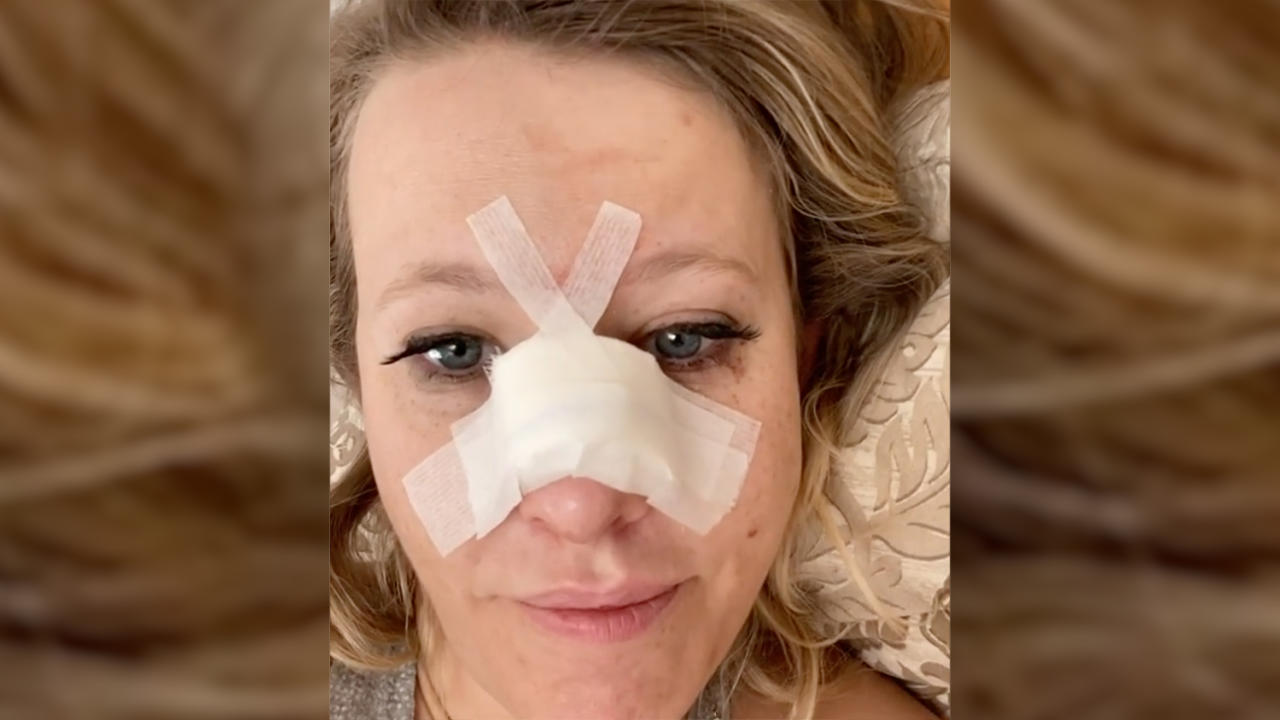 Ксения Собчак сломала нос и получила сотрясение