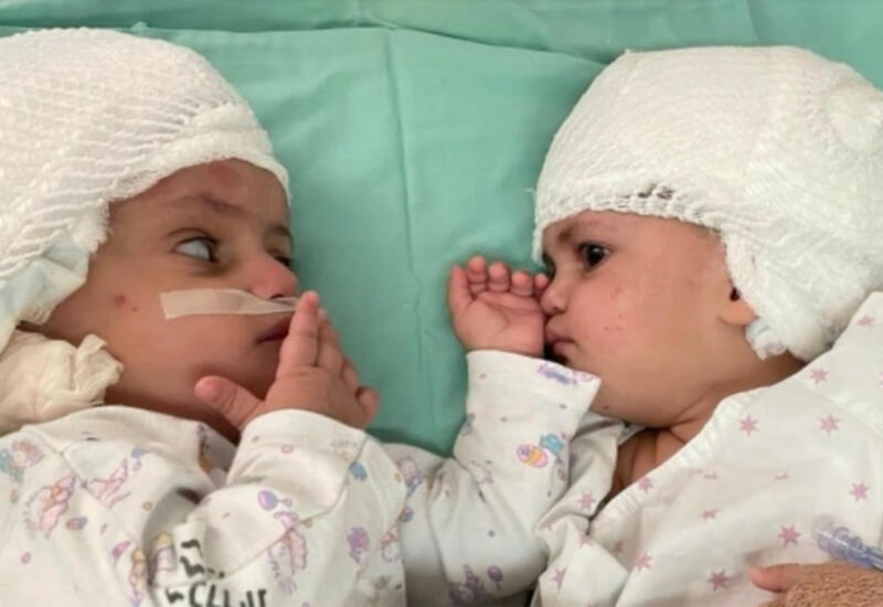 В Израиле провели редкую операцию по разделению сиамских близнецов