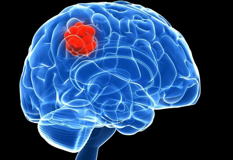 Создан эффективный способ лечения смертоносной опухоли мозга