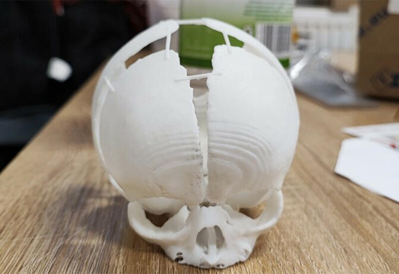 Инженеры создали 3D-череп для младенца, родившегося без затылка