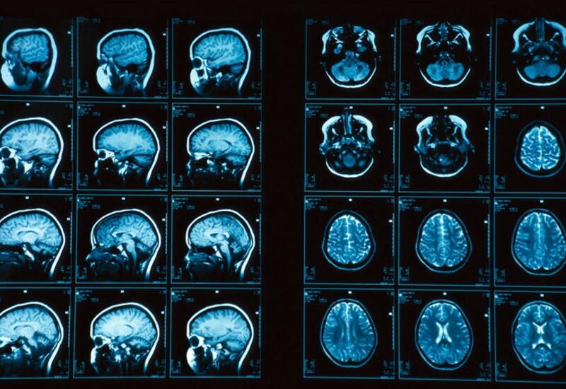 МРТ позволило увидеть признаки мигрени в мозгу человека