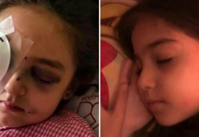В Иране в результате открытого полицейскими огня девочка потеряла глаз
