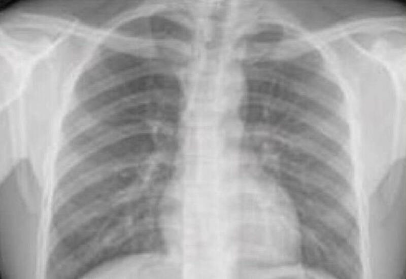 Нейросеть научилась выявлять болезни сердца по рентгеновскому снимку