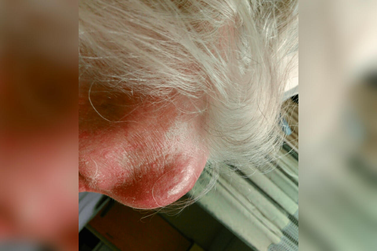 Врачи излечили опухоль на лбу 92-летней женщины