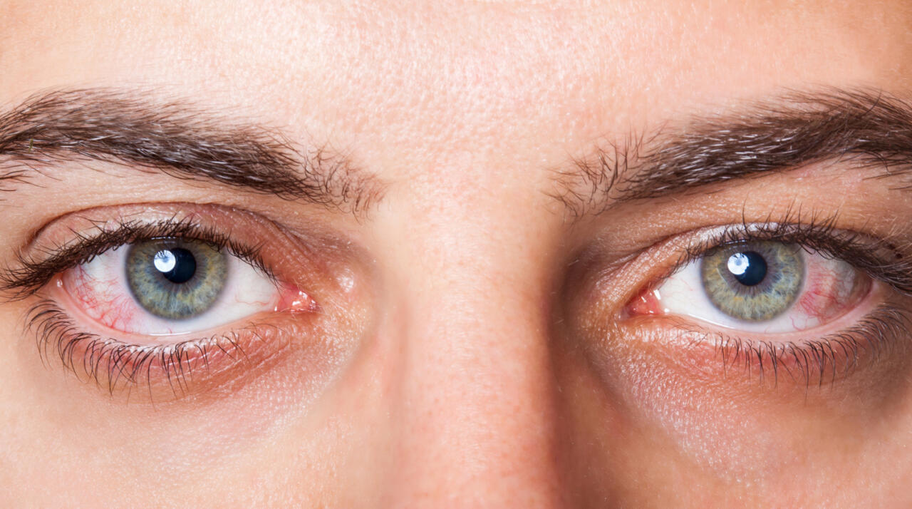 Созданы контактные линзы для лечения синдрома сухого глаза
