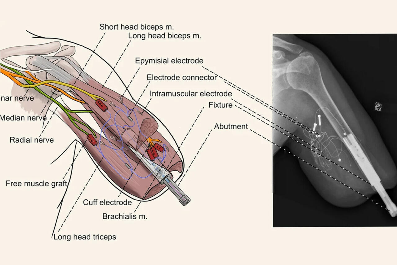 Создан бионический имплантат, позволяющий контролировать все пальцы протеза