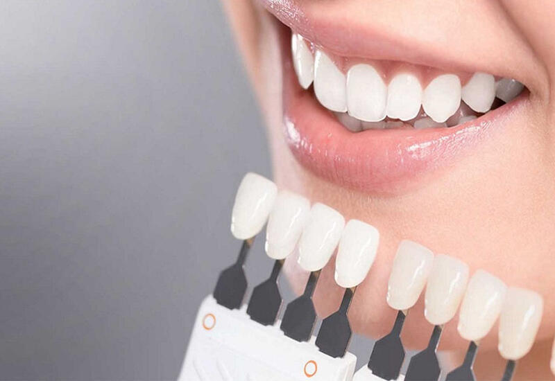 Стоматолог перечислил противопоказания к отбеливанию зубов