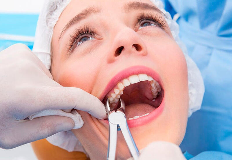 Стоматолог перечислил показания к удалению зубов мудрости