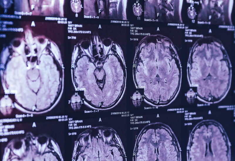Ученому из Канады запретили исследовать загадочную болезнь мозга