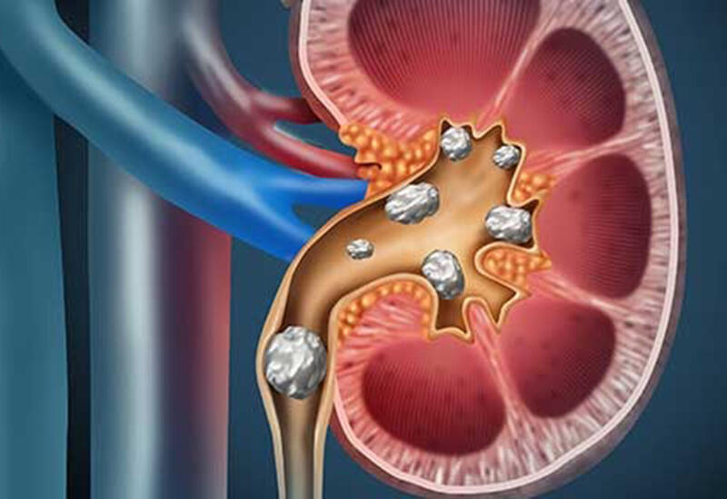 Названа процедура, снижающая риск повторного образования камней в почках