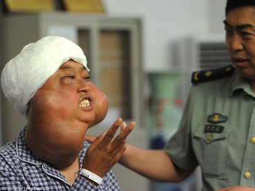 Китаянке удалили 70 опухолей, обезобразивших ее лицо - ФОТО
