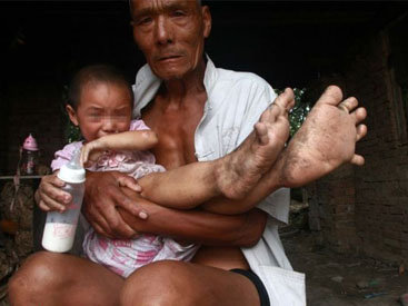 У китайской девочки ноги растут в несколько раз быстрее остального тела - ФОТО