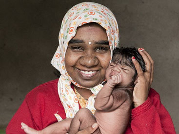 В Индии родился необыкновенный ребенок-оборотень - ФОТО