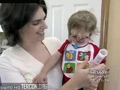 Синдром Гольденхара Фото Что Это Такое