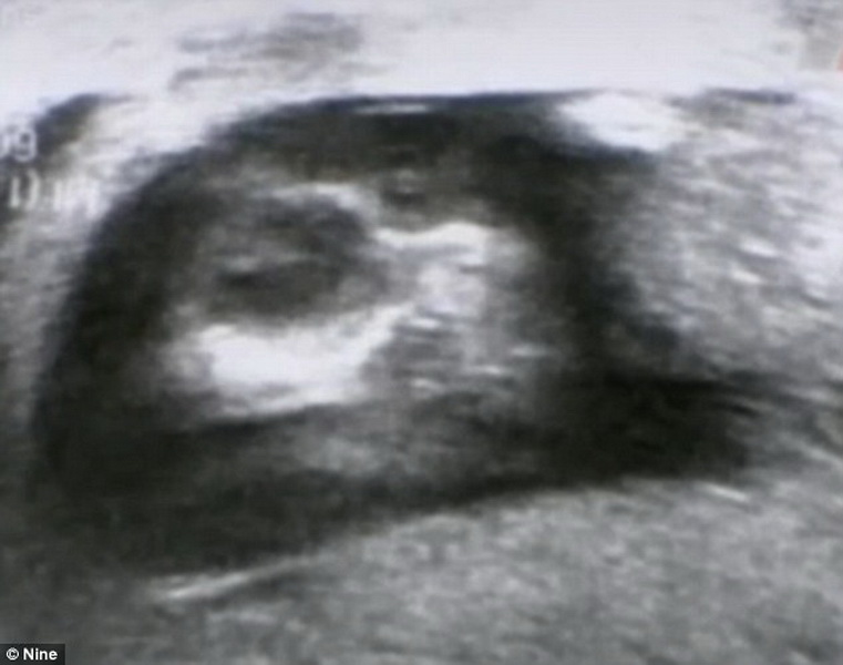 Женщина готовится родить двухголового ребенка - ФОТО