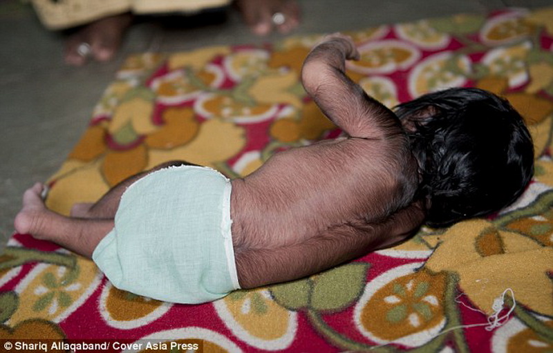 В Индии родился необыкновенный ребенок-оборотень - ФОТО