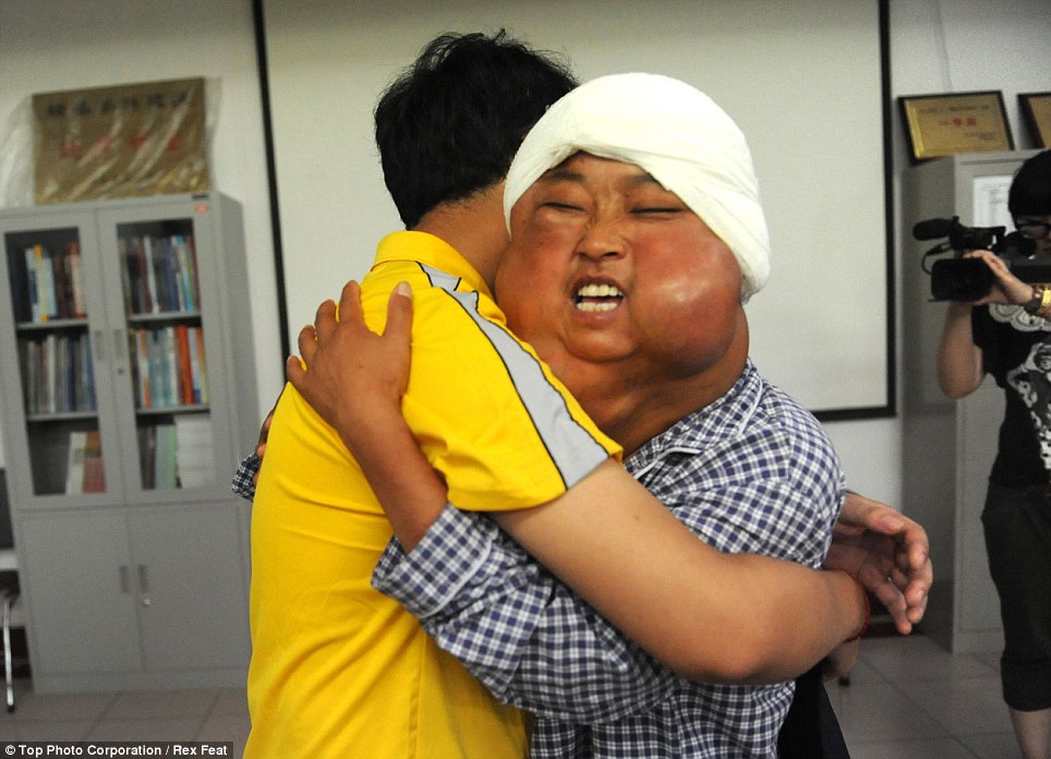 Китаянке удалили 70 опухолей, обезобразивших ее лицо - ФОТО