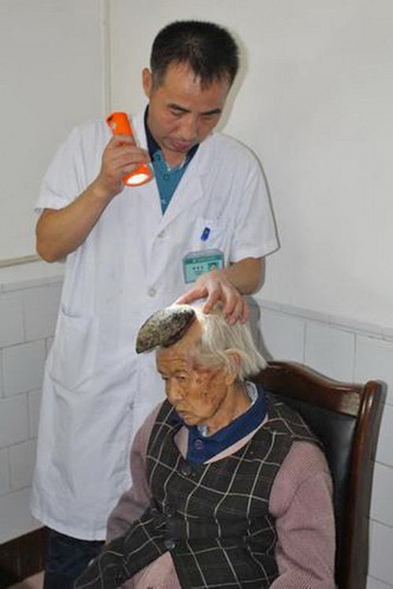 У пожилой китаянки на голове вырос рог - ФОТО