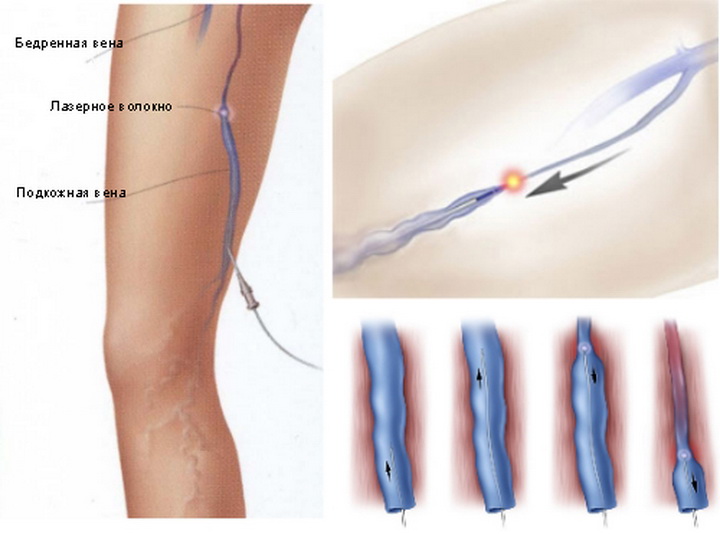 Что делают вены. Эндовазальная лазерная коагуляция вен. Склеротерапия варикозной болезни.