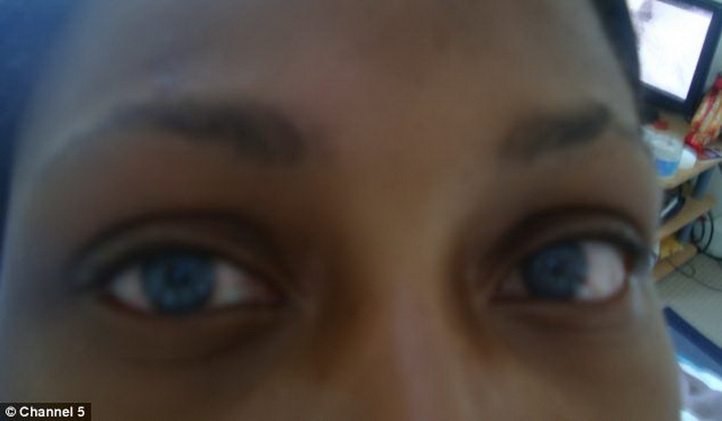 Девушка ослепла после операции по изменению цвета глаз - ФОТО